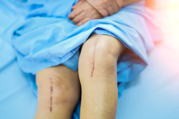 Asian senior or elderly old lady woman patient show her scars surgical total knee joint replacement Suture wound surgery arthroplasty on bed in nursing hospital ward : healthy strong medical concept.