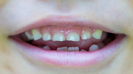 Six-year-old boy smiles, showing calf's teeth, mouth macro close-up