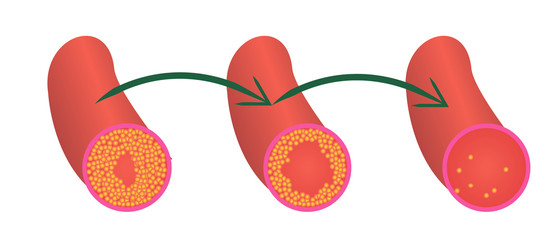 Reduce Levels of cholesterol plaque in vessels