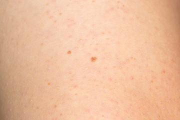 Close up of keratosis pilaris on the arm of a young caucasian man
