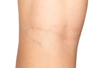 Fototapeta na wymiar varicose veins on the back of the knee of a young caucasian woman