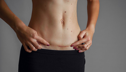 Closeup of woman belly with a scar from a cesarean section