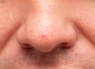 pimple on the nose