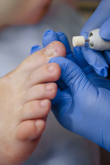 Podology treatment. Podiatrist treats foot. Podiatry doctor or dermatologist treats the patient in...