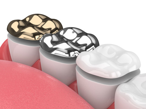 3d render of teeth with onlay