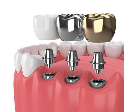 3d render of teeth with implants