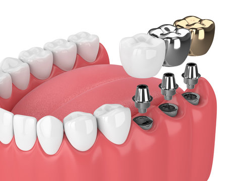 3d render of teeth with implants