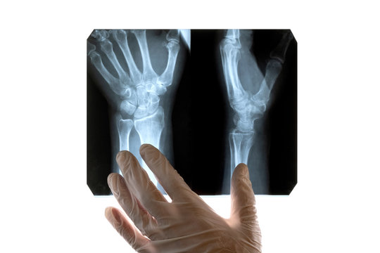 A doctor in white gloves examines an X-ray of a damaged hand. Close-up. Concept on a medical theme, day of radiologist or surgeon. Isolate on white background. Copy space.