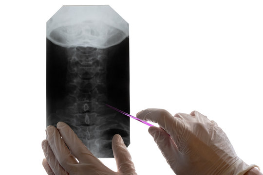 A doctor in white gloves examines an x-ray of the cervical vertebrae. Concept on the topic of medical education, day of the radiologist or surgeon. Close-up. Isolate on white background. Copy space.