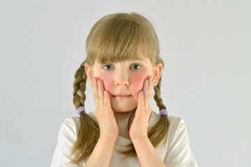 child, kid, has skin disease dermatitis redness irritation