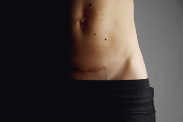 Closeup of woman belly with a scar from a cesarean section