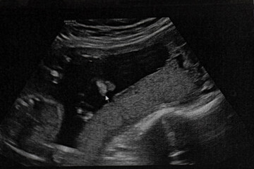 Ultrasound of baby in pregnant woman.