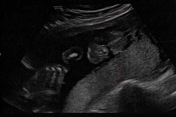 Ultrasound of baby in pregnant woman.