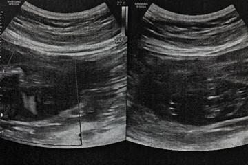 Ultrasound of baby in pregnant woman.