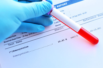 Laboratory result of homocysteine test with blood sample