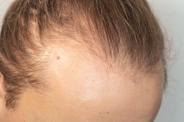 Receding hairline of a young caucasian man