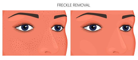 Vector illustration. Freckle removal on woman face (half turn) before, after cosmetic procedure. Close up view. For advertising of whitening medicinal, pharmacy products, cream, lotion