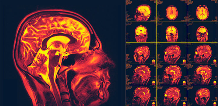 Magnetic resonance imaging of the brain. MRI scan
