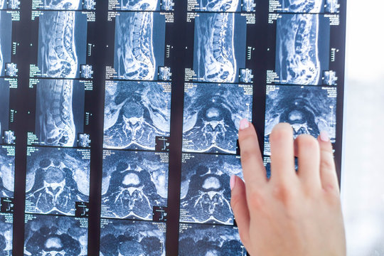 MRI of the back of the vertebral section, hernia in the intervertebrates close-up
