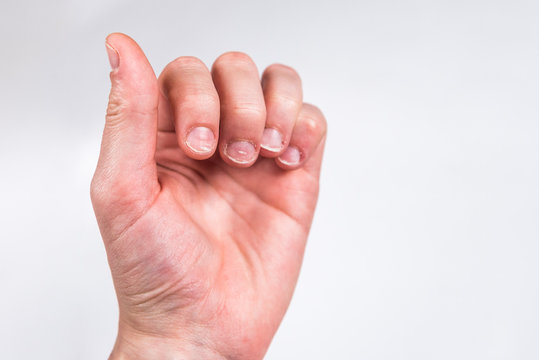 Fingers with badly or chewed bitten nails on gray background.