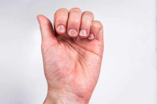 Fingers with badly or chewed bitten nails on gray background.