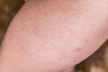 Women fat hips with stretch marks. 