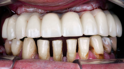 Dental prosthesis set time after implantation of a polymer