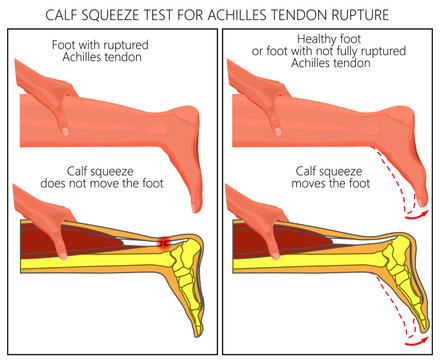 Illustration of a calf squeeze test Achilles tendon rupture. External and Skeletal view of an ankle