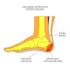Illustration of an ankle (side view) with children's disease Calcaneal Apophysitis, inflammation of the growth plate of the heel