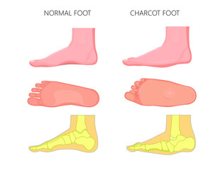 Illustration of normal and rocker bottom Charcot foot (soles of the feet and medial view shows deformity of the foot).