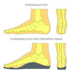 Illustration of Flat foot without and with orthopedic insole. Side and back views.
