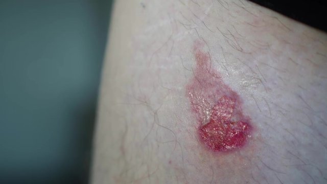 Extreme macro close up of a second degree open wound burn and blisters.