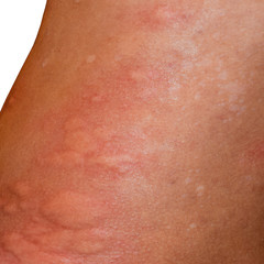 Fototapeta premium Allergy skin back and sides. Allergic reactions on the skin in t