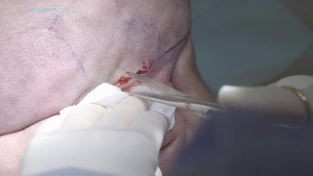 Surgeon cuts the tissues of the head with surgical scissors macro (4K, 25fps)