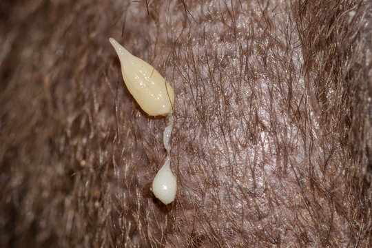 Dipylidium caninum gravid proglottid in the cat's perianal region.