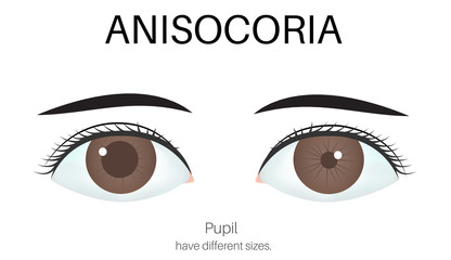 Image of eye with anisocoria