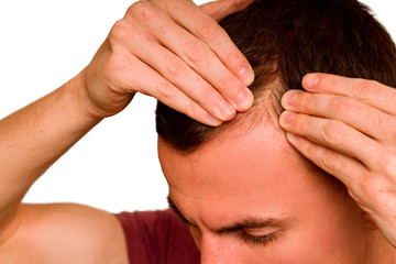 The guy spreads the hair on his head with his hands. Problem of hair loss in men.