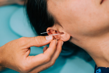Physiotherapist doing acupuncture to a young woman on her ear