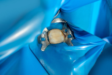 two chewing side teeth of the upper jaw after treatment of caries. Restoration of the chewing surface with a photopolymer filling material using the Rubber Dam system © Сергей Кучугурный