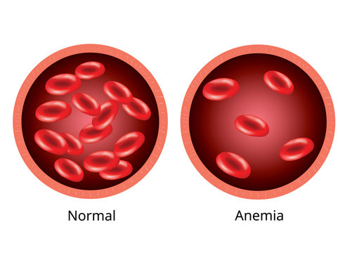 Infographic image, Blood of healthy human and blood vessel with anemia.