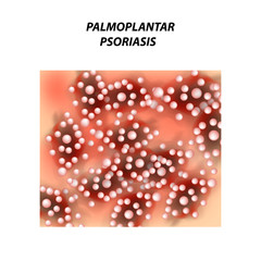 Palmoplantic psoriasis. Eczema, dermatitis skin disease psoriasis. Infographics. Vector illustration on isolated background.