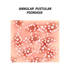 Annular pustular psoriasis. Eczema, dermatitis skin disease psoriasis. Infographics. Vector illustration on isolated background.