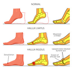 Illustration (diagram) of normal function, limited motion and rigid deformity (with degenerative arthritis) of the first metatarsophalangeal joint of the foot