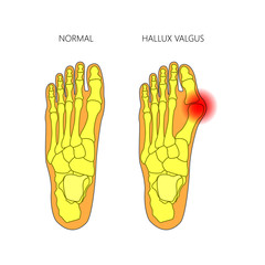 Illustration of the normal foot and valgus deviation of the first toe.