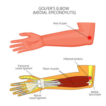Illustration of Medial Epicondylitis or golfer's elbow.  Used: Gradient, transparency, blend mode. For medical publications.