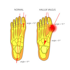 Illustration of the normal foot and hallux valgus with indicating of the first metatarsophalangeal and the first-second intermetatarsal angles