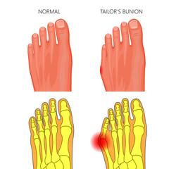 Illustration of the normal foot and Tailor's bunion. External and skeletal views.  Used: gradient, transparency