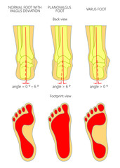 Illustration of normal,  Planovalgus and varus  feet with footprint.