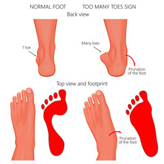 Vector illustration of the normal human foot and the foot with pronation or flatfoot, with hindfoot deformity. Too many toes sign.