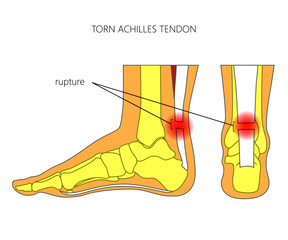 Illustration of Skeletal ankle (side view and back view) with torn Achilles tendon